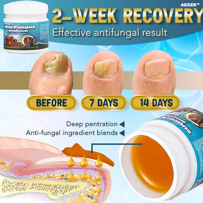 Aexzr™ 5X Quick-healing Nail Fungus Ointment